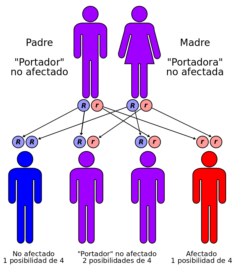 Enfermedad de Tay-Sachs. Wikimedia Commons